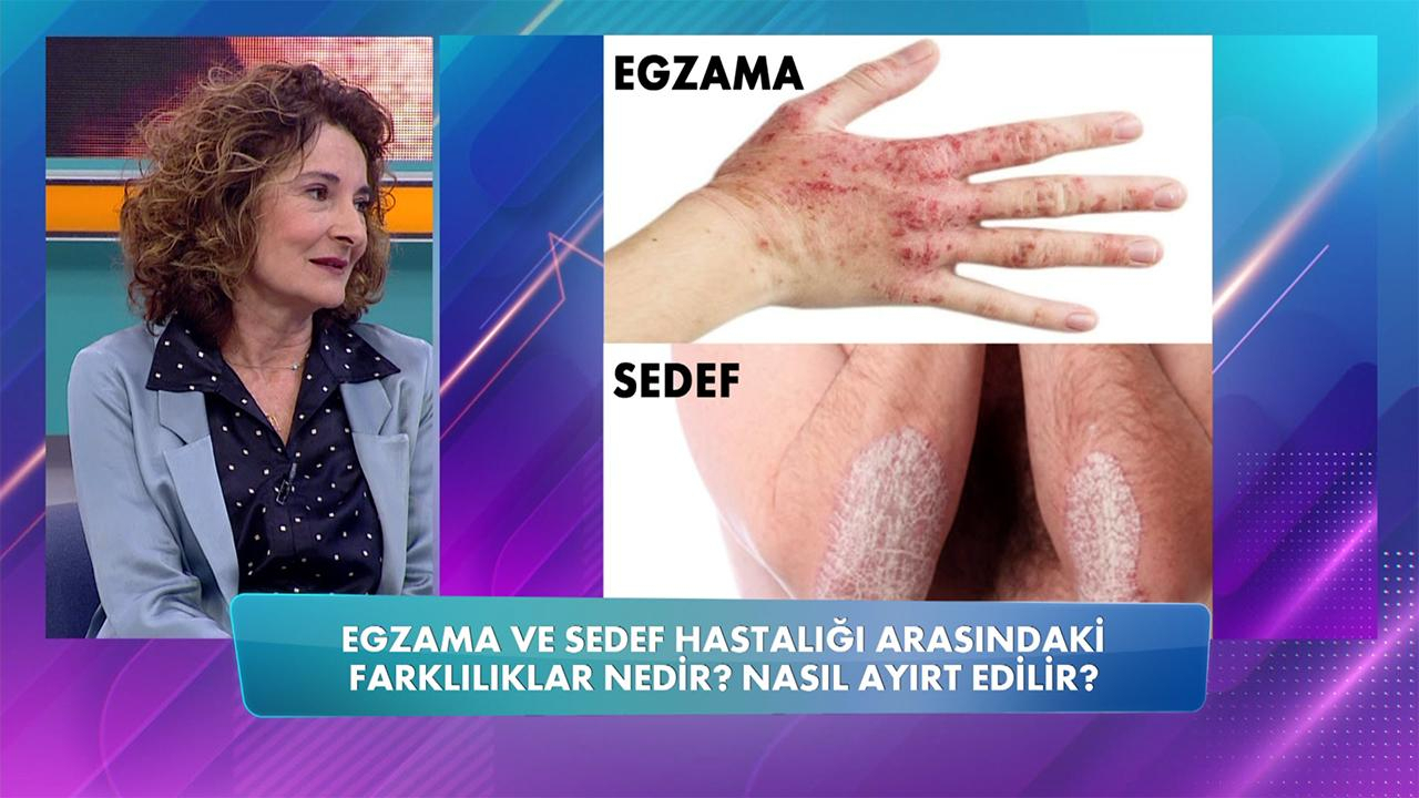 Egzama ve sedef hastalığı bulaşıcı mıdır?