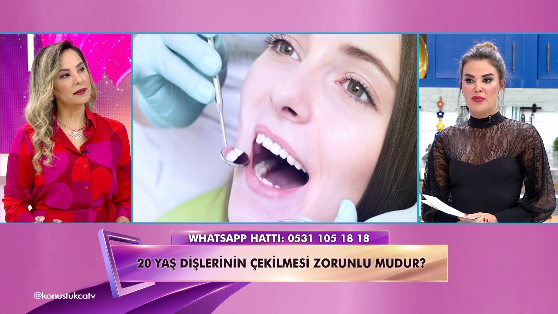 20 yaş dişleri hakkında bilinmeyenler!