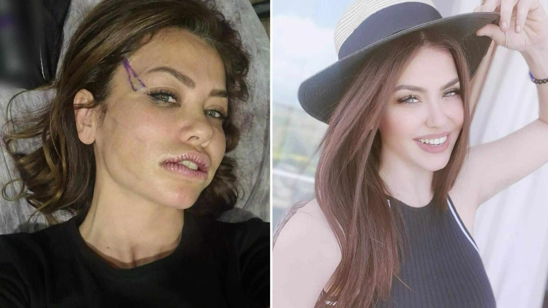 Lara’nın estetik sonrası hali şaşırttı!