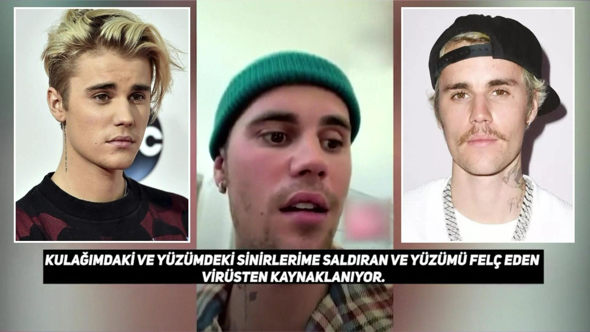 Justin Bieber’dan yüz felci şoku!